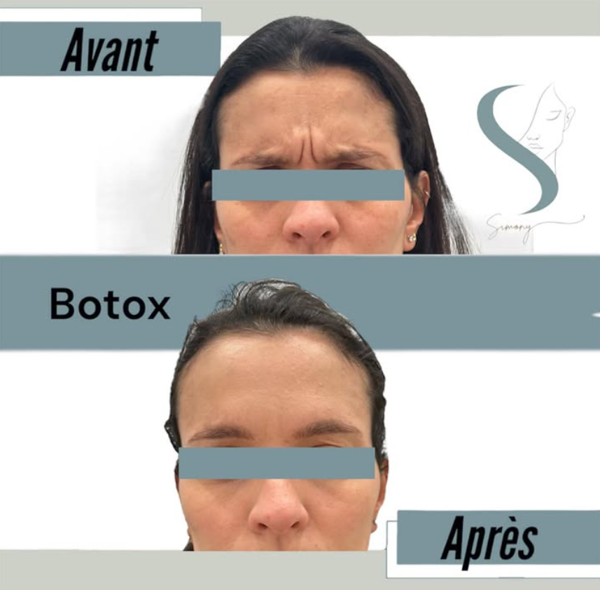 Antes e depois — resultado 1