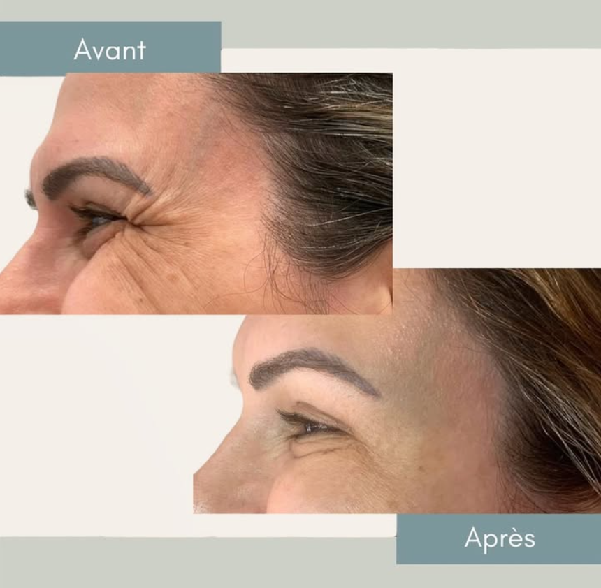 Antes e depois — resultado 2