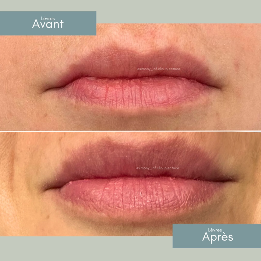 Antes e depois — resultado 3