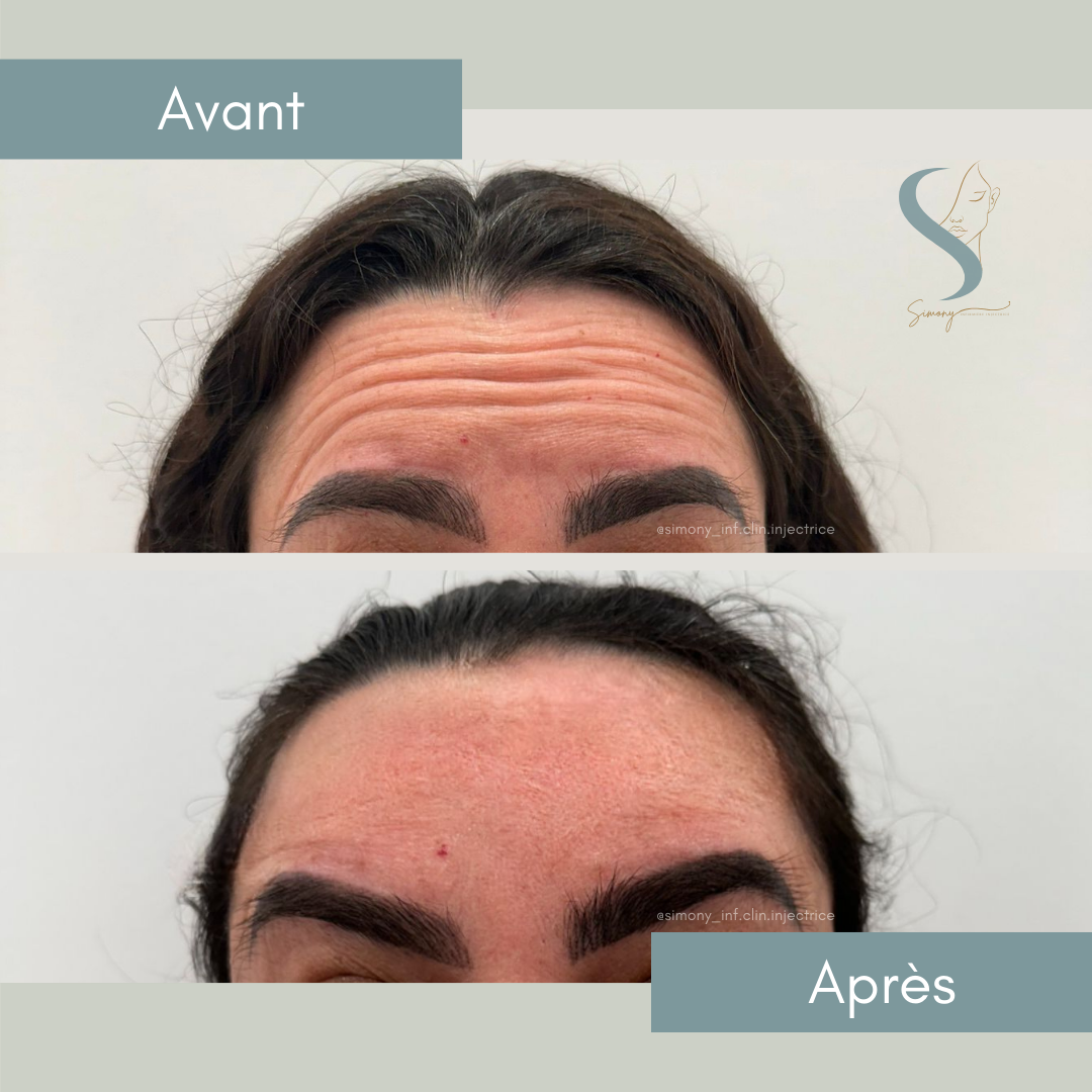 Antes e depois — resultado 4